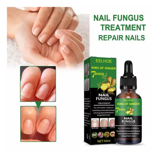 FUNGUS FREE NAILS® DILE ADIOS A LOS HONGOS , RECUPERA LA BELLEZA Y SALUD DE TUS UÑAS
