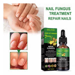 FUNGUS FREE NAILS® DILE ADIOS A LOS HONGOS , RECUPERA LA BELLEZA Y SALUD DE TUS UÑAS