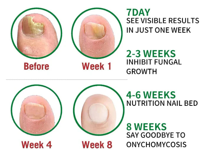 FUNGUS FREE NAILS® DILE ADIOS A LOS HONGOS , RECUPERA LA BELLEZA Y SALUD DE TUS UÑAS