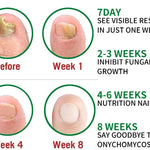 FUNGUS FREE NAILS® DILE ADIOS A LOS HONGOS , RECUPERA LA BELLEZA Y SALUD DE TUS UÑAS