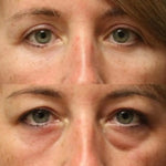 2X1/ Parches de Microagujas + Ácido hialurónico para ojeras, bolsas y arrugas